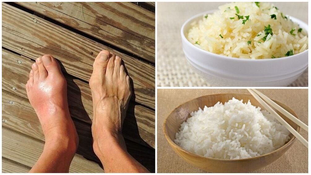 In patients with gout, a rice-based diet is recommended. 